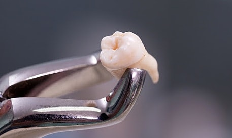 Bác sĩ Mỹ bị kiện sau khi khách chết vì nhổ răng