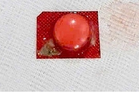 Viên thuốc nguyên vỉ kẹt trong phế quản người đàn ông