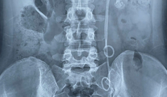 Người phụ nữ 33 tuổi đau tức thắt lưng, tiểu buốt, bác sĩ gắp ra thứ "đáng sợ" bên trong