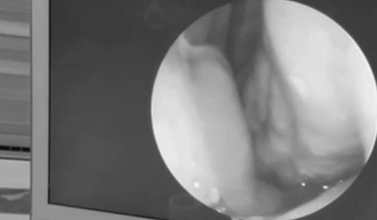 Người đàn ông 60 tuổi liên tục chảy máu mũi, bác sĩ gắp ra thứ "đáng sợ" bên trong