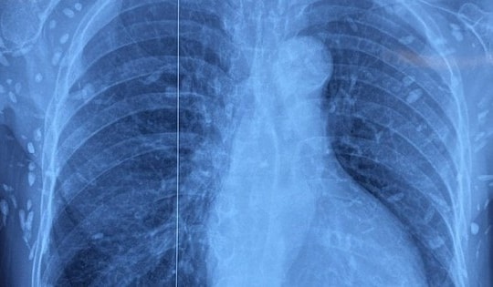 Chụp X-quang ngực cho người phụ nữ 77 tuổi, bác sĩ sốc nặng khi phát hiện "bí mật đáng sợ"