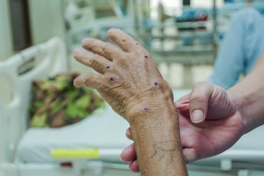 Đàn ong vò vẽ đốt 117 nốt khiến người đàn ông sốc phản vệ nặng