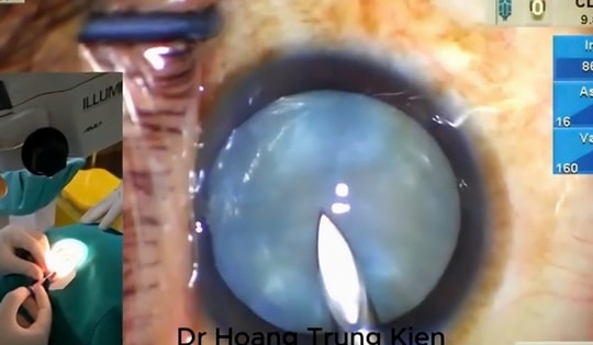 Đột phá mới trong phẫu thuật đục thủy tinh thể chín trắng căng phồng