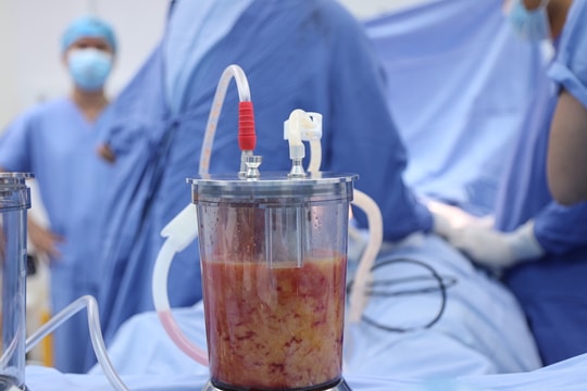 Thắc mắc thường gặp về hút mỡ thẩm mỹ