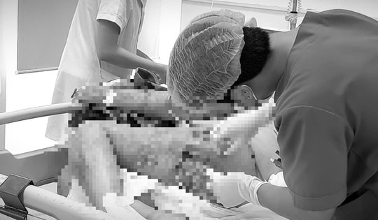 Nguy kịch sau khi tự trích mụn nhọt tại nhà