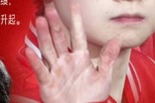 Bàn tay biến dạng của ngôi sao bóng bàn Trung Quốc