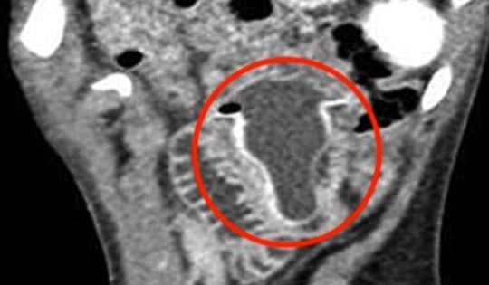 Bé trai 10 tuổi nôn mửa, đau bụng suốt 4 ngày, bác sĩ sốc nặng khi phát hiện "bí mật" đáng sợ