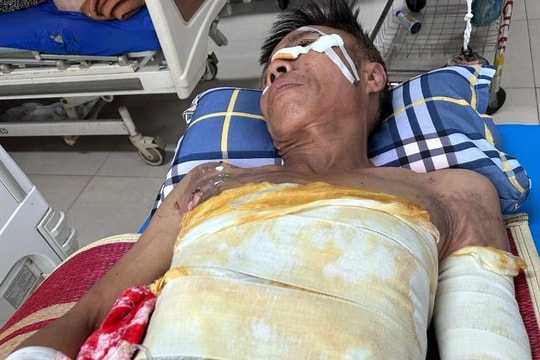 Con gái khẩn cầu cứu cha nghèo đơn thân bị điện giật bỏng nặng khi làm thuê