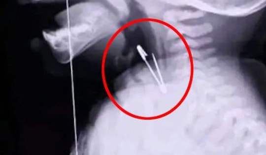 Chụp X-quang họng bé trai 7 tháng tuổi, bác sĩ sốc nặng khi phát hiện "bí mật" đáng sợ