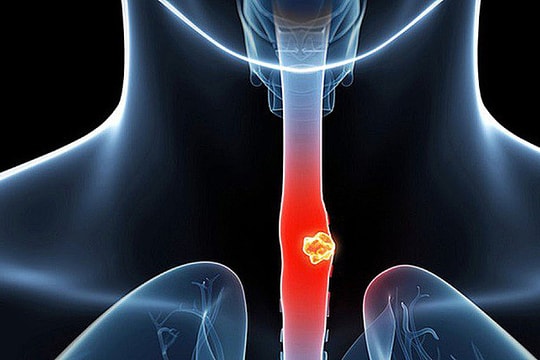 Phát hiện hai loại ung thư sau dấu hiệu đau bụng