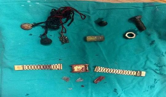 Người đàn ông đau bụng đi khám, bác sĩ phát hiện "bí mật" bên trong