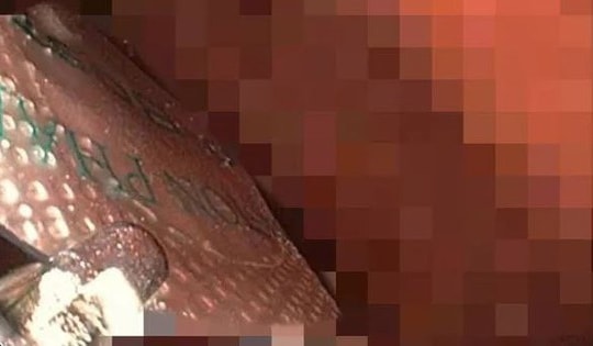 Người đàn ông 52 tuổi nhập viện trong tình trạng đau bụng, bác sĩ phát hiện lý do "đáng sợ" phía sau