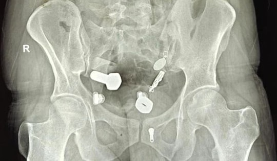 Người đàn ông 34 tuổi bị đau bụng, bác sĩ sốc khi phát hiện thứ "đáng sợ" bên trong