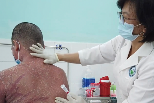 Vảy nến - bệnh gây nỗi đau thể xác lẫn tinh thần