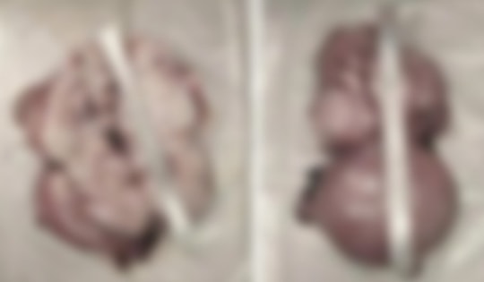 Người phụ nữ 47 tuổi bụng to như mang song thai, bác sĩ lấy ra "thứ đáng sợ"