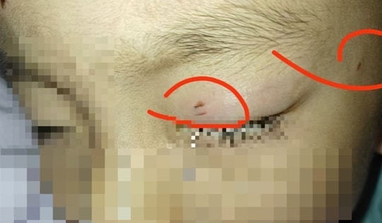 Cậu bé bị nhiễm trùng, mù một bên mắt vì hành động của giáo viên