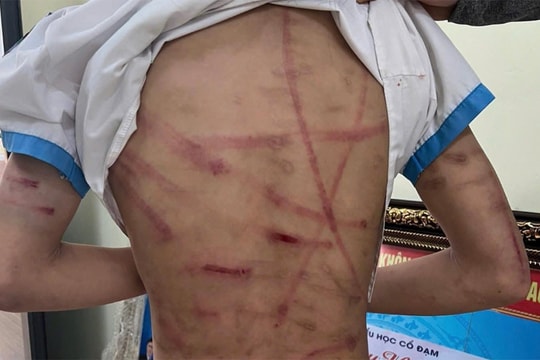 Nghi án bé gái lớp 5 bị cha dượng bạo hành