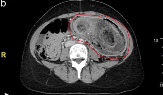 Thiếu nữ 17 tuổi liên tục đau bụng, nôn ói, bác sĩ sốc nặng khi phát hiện "bí mật" đáng sợ