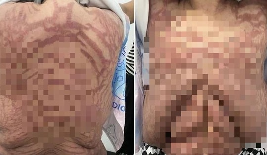 Người phụ nữ 40 tuổi, da biến dạng kinh hoàng vì sai lầm nhiều người mắc