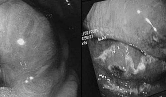 "Thủ phạm" khiến người đàn ông 68 tuổi nguy kịch, dạ dày và thực quản hoại tử nặng