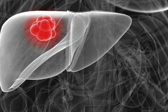 Những dấu hiệu thường gặp cảnh báo gan tổn thương