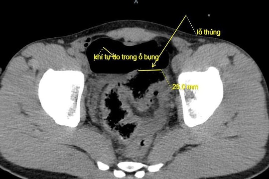 Dùng vòi nước rửa ôtô xịt hậu môn gây thủng đại tràng