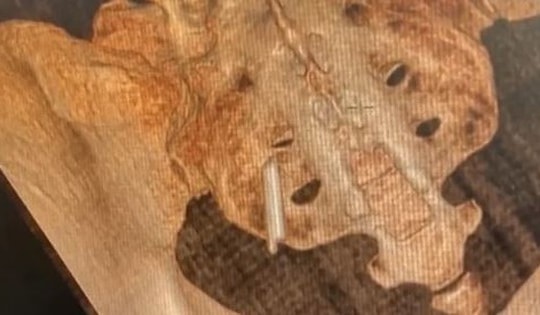 Đi khám vì ngã xe, người phụ nữ sốc nặng khi phát hiện bí mật "đáng sợ" suốt 22 năm