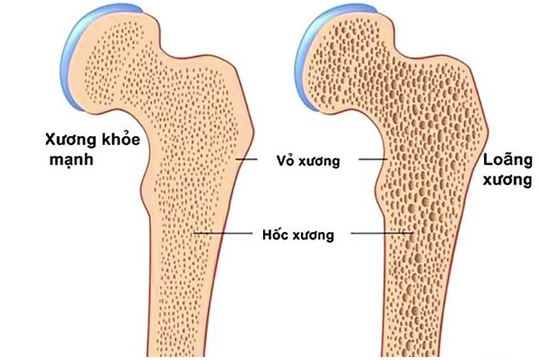 Loãng xương tiến triển âm thầm