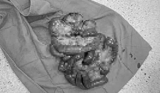 Người đàn ông 60 tuổi đau bụng dữ dội, bác sĩ gắp ra thứ "đáng sợ" bên trong