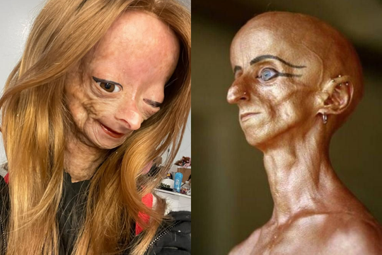 Hội chứng lão nhi: Khi một đứa trẻ mắc kẹt trong cơ thể người già