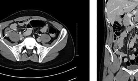 Người đàn ông 29 tuổi đau bụng dữ dội, bác sĩ sốc nặng khi phát hiện "bí mật" đáng sợ