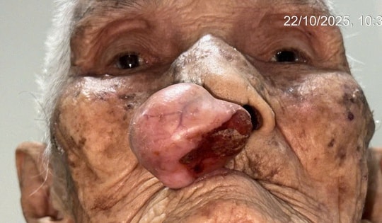 Phẫu thuật cho cụ bà gần 100 tuổi sau 30 năm sống chung với khối u trên mặt