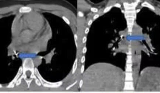 Bé trai 13 tuổi ho sặc sụa, bác sĩ gắp ra thứ "đáng sợ" bên trong