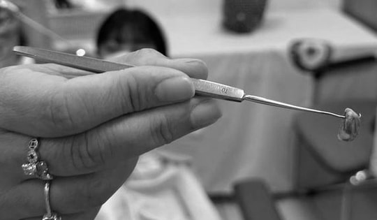 Bé 3 tuổi chảy nước mũi có mùi hôi khó chịu, bác sĩ gắp ra thứ "đáng sợ" bên trong