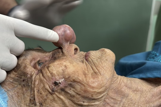 Ca mổ đặc biệt ‘vì thương’ giúp cụ bà gần 100 tuổi thoát khối u che lấp mũi, miệng