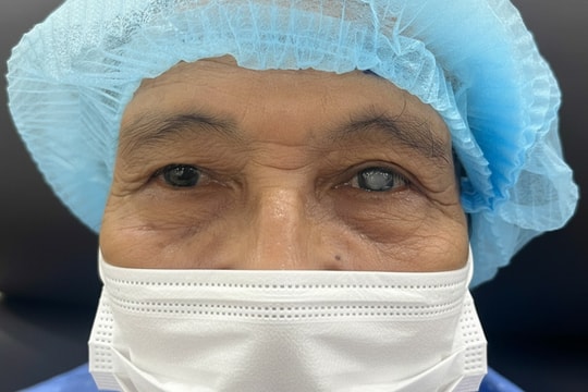 Mắt trắng xóa do đục thủy tinh thể