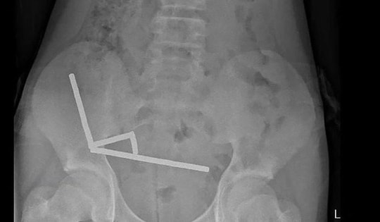 Cậu bé đau bụng trong 4 ngày, bác sĩ phát hiện ra thứ đáng sợ