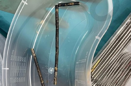 Nuốt 100 viên nam châm, bé trai 13 tuổi phải cắt ruột