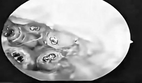 Người phụ nữ 48 tuổi đau tai dữ dội, bác sĩ gắp ra "thứ đáng sợ" bên trong