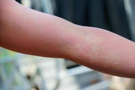 Giải mã 'cơn bão' mề đay sau sinh