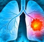 Khám sức khỏe định kỳ, hai phụ nữ bất ngờ nhận chẩn đoán ung thư phổi