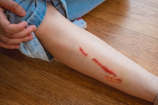 Vết chó cắn nhức, mưng mủ có phải nhiễm trùng không?