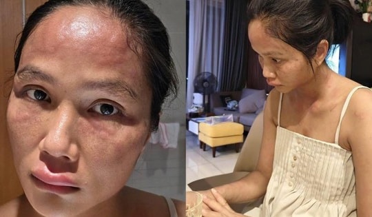 Động thái gây chú ý của H'Hen Niê sau chia sẻ về bệnh nổi mề đay sau sinh