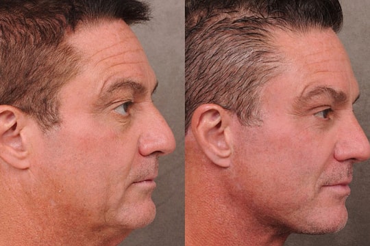 Áp lực 'già là đào thải', kỹ sư công nghệ đổ tiền thẩm mỹ