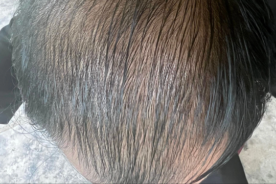 Dấu hiệu cảnh báo nam giới ngoài 35 tuổi thiếu hụt protein