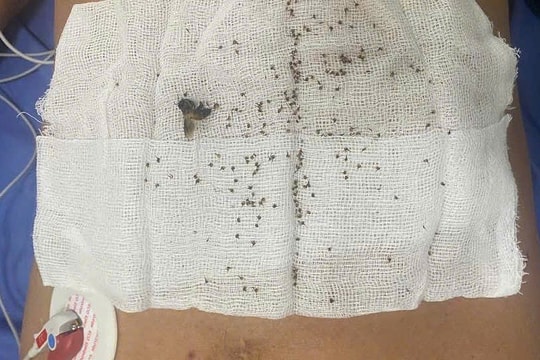 Thoát chết sau khi bị hơn 300 con ong khoái đốt