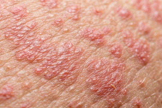 Vaccine thủy đậu có phòng được bệnh zona thần kinh?