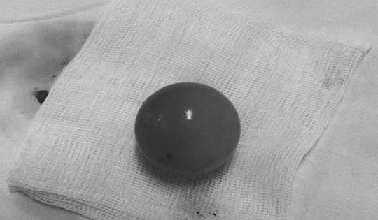 Bé trai 14 tháng tuổi nôn nhiều, bố mẹ bất ngờ khi bác sĩ gắp ra thứ "đáng sợ" trong bụng