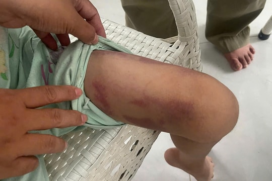 Mẹ cùng người tình bị bắt vì bạo hành con gái 9 tuổi