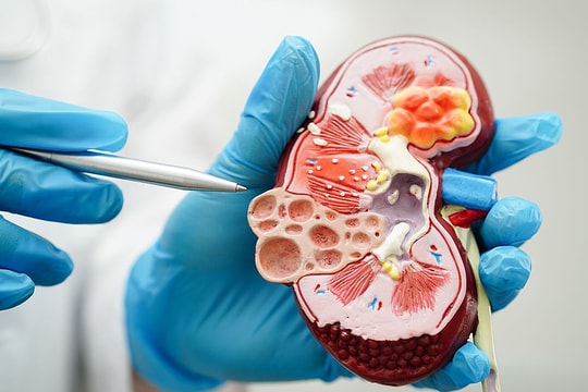 Huyết áp cao - 'kẻ giết người thầm lặng' hủy hoại thận